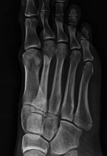 5th Metatarsal Stress Fracture